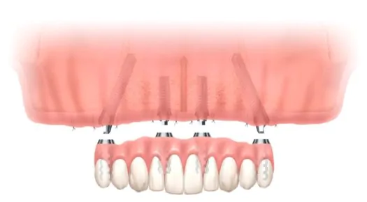 総入れ歯・歯がほとんどない方へのインプラント治療