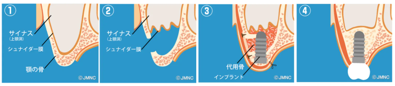 サイナスリフト