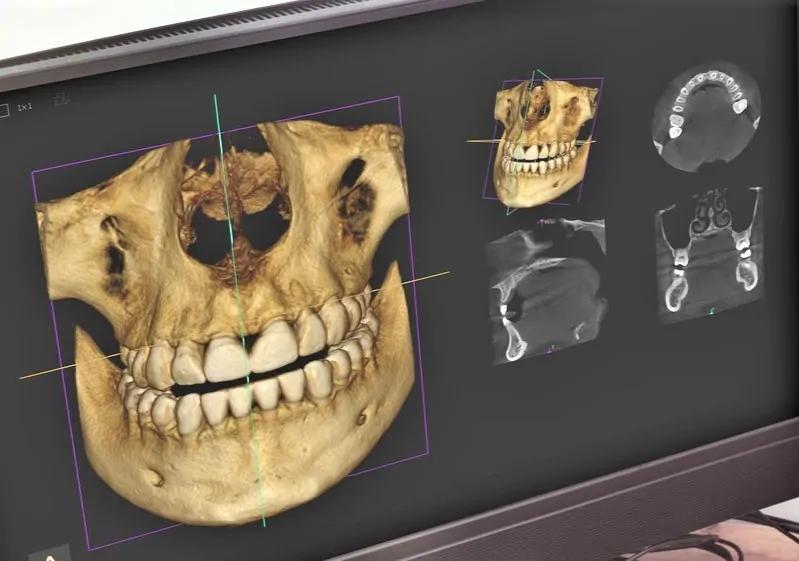 安全で確実なインプラント治療を行うためのCT検査