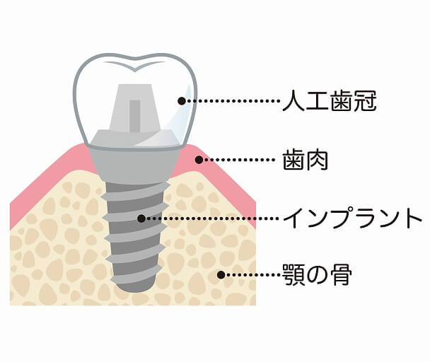 インプラントガイドの使用