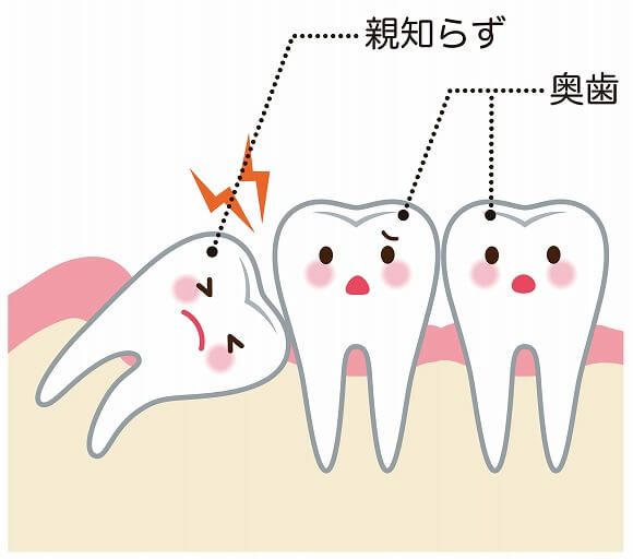 親知らず（智歯）について