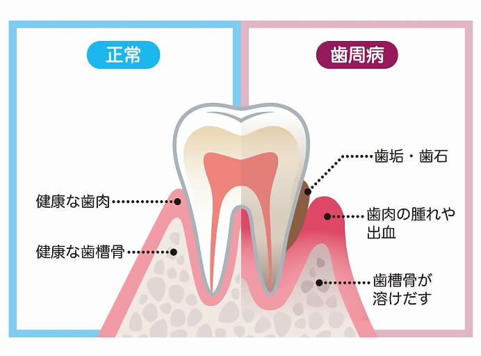 歯周病治療