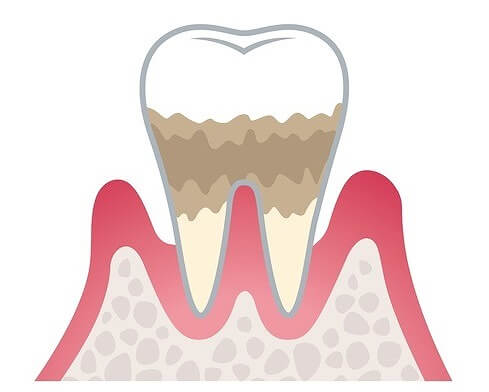 歯周炎（中度）
