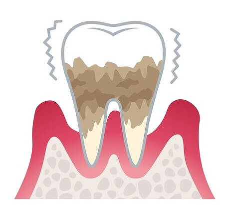 歯周炎（重度）
