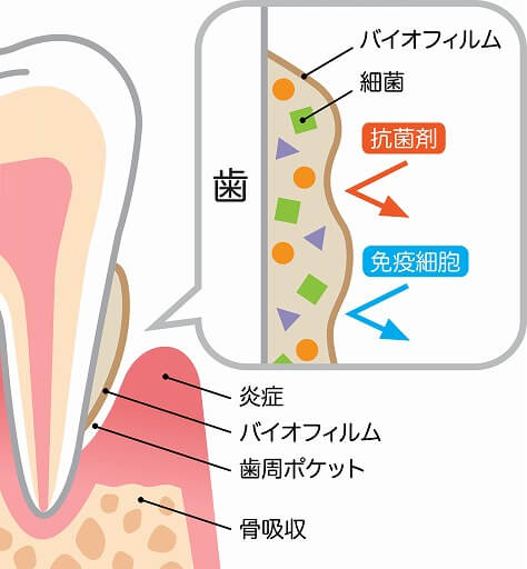 歯周病の原因